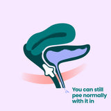 Illustration of a urinary system with the Uresta inserted. Text reads, "You can still pee normally with it in."